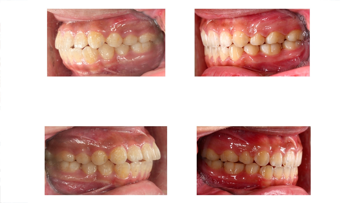 暴牙牙齒矯正對照圖三