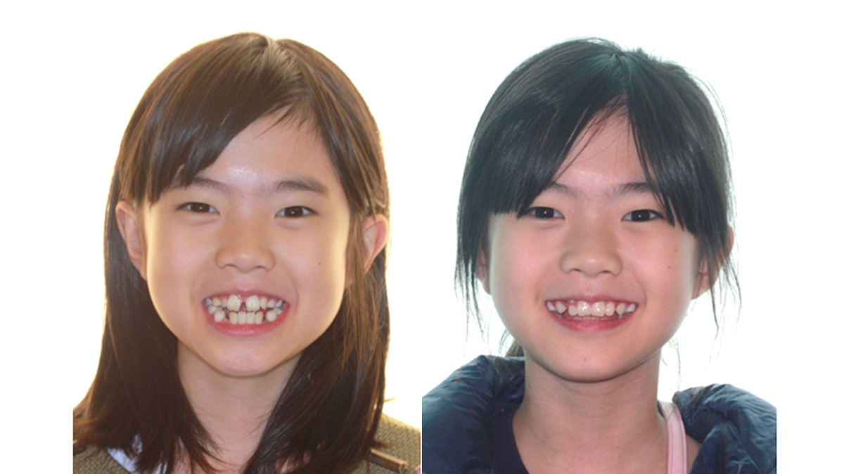 兒童牙齒矯正矯正對照圖