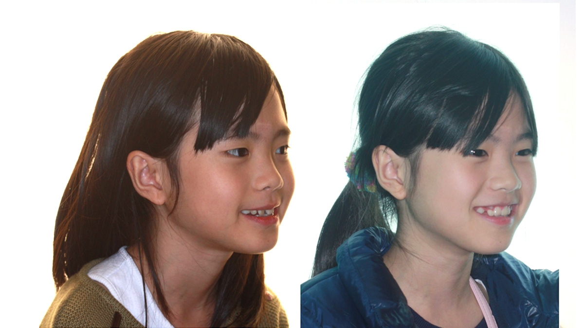 兒童牙齒矯正矯正對照圖二