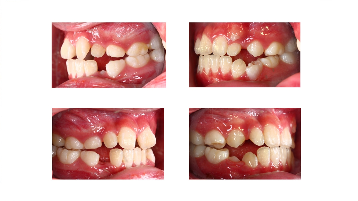 兒童牙齒矯正矯正對照圖三