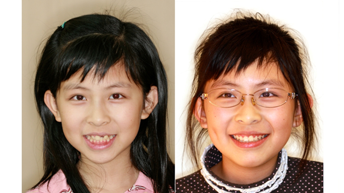 兒童牙齒矯正矯正對照圖
