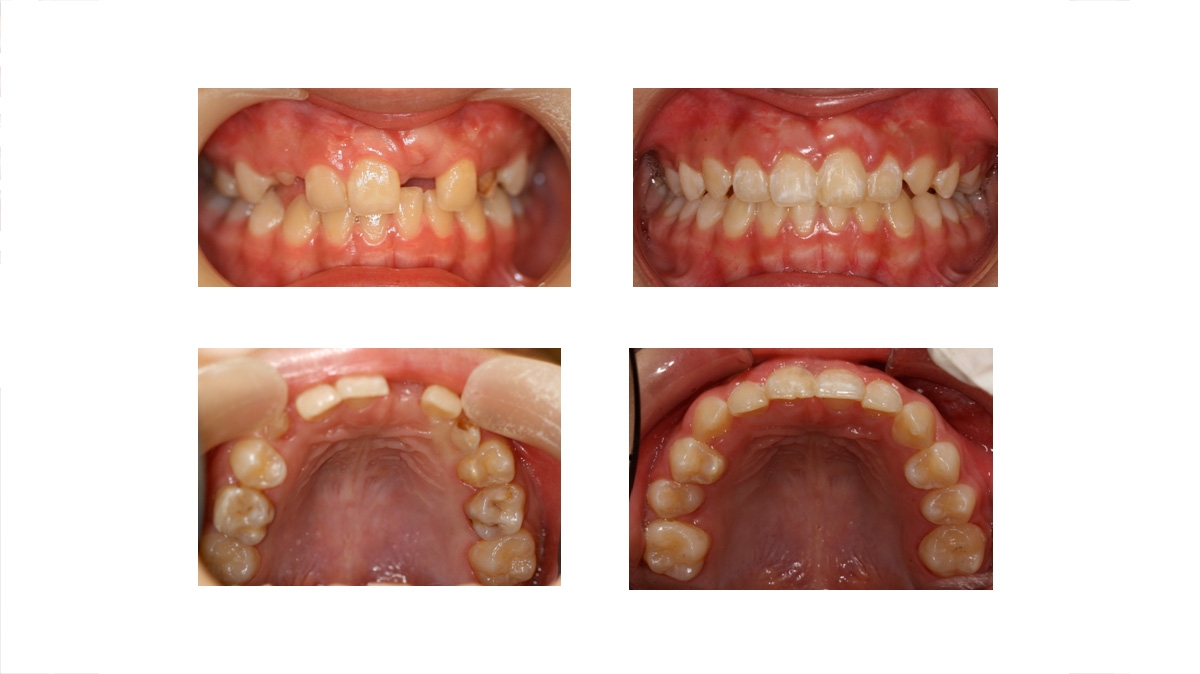 兒童牙齒矯正矯正對照圖二