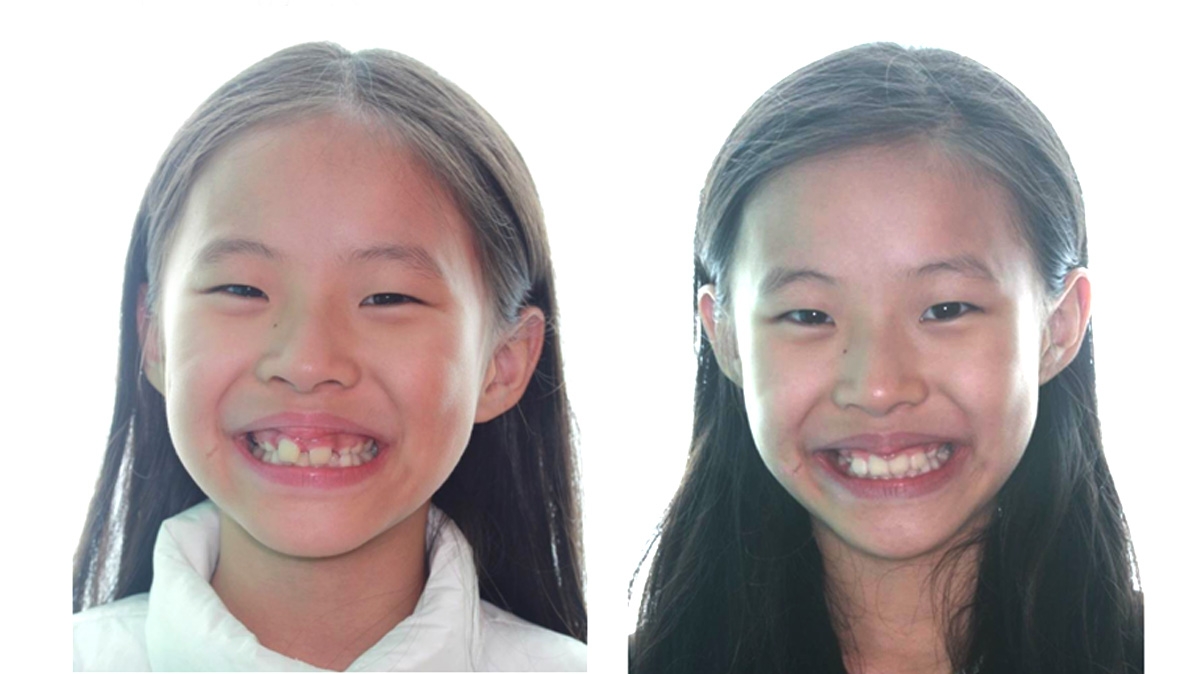 兒童牙齒矯正矯正對照圖