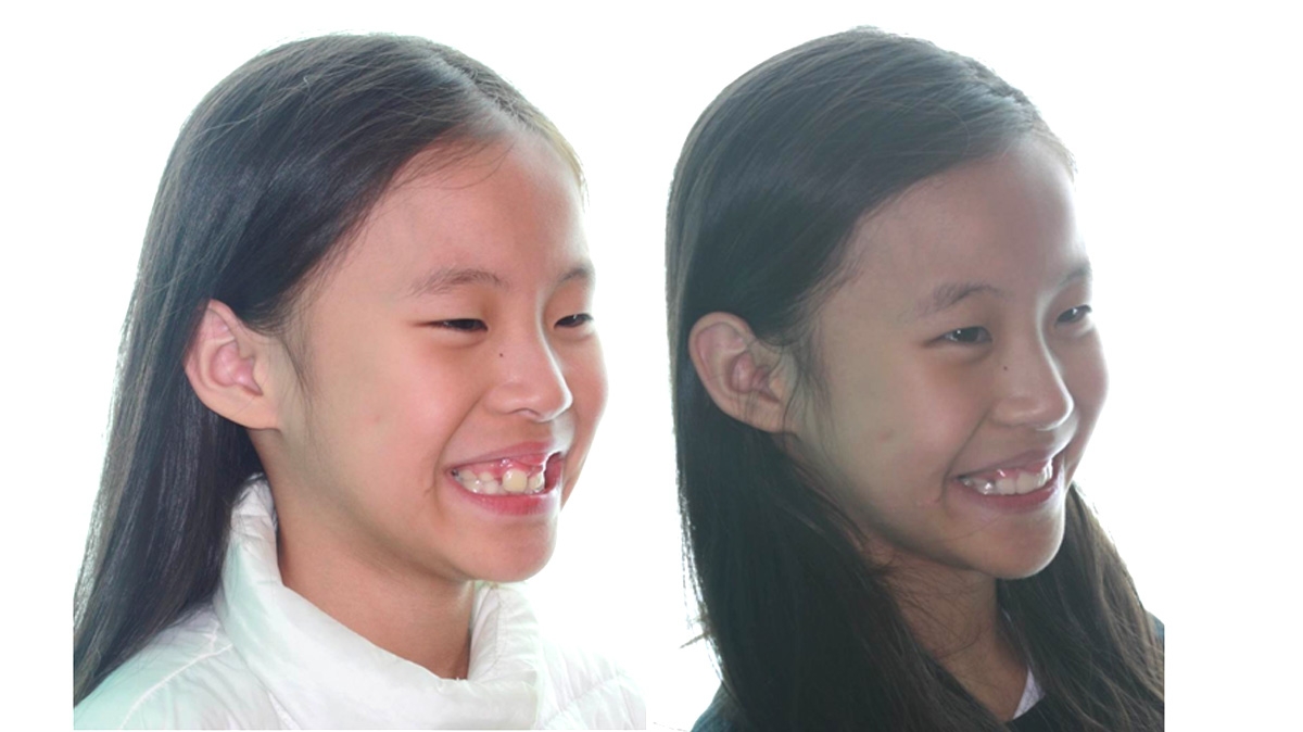 兒童牙齒矯正矯正對照圖二