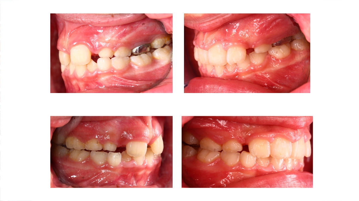 兒童牙齒矯正矯正對照圖三