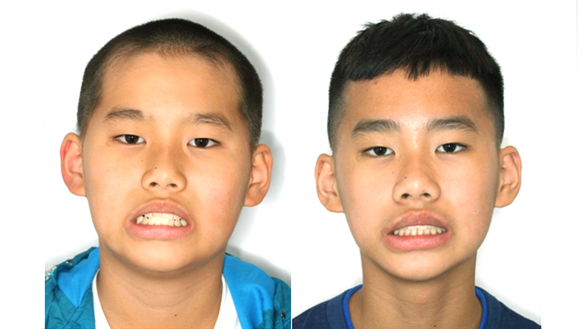 兒童牙齒矯正矯正對照圖