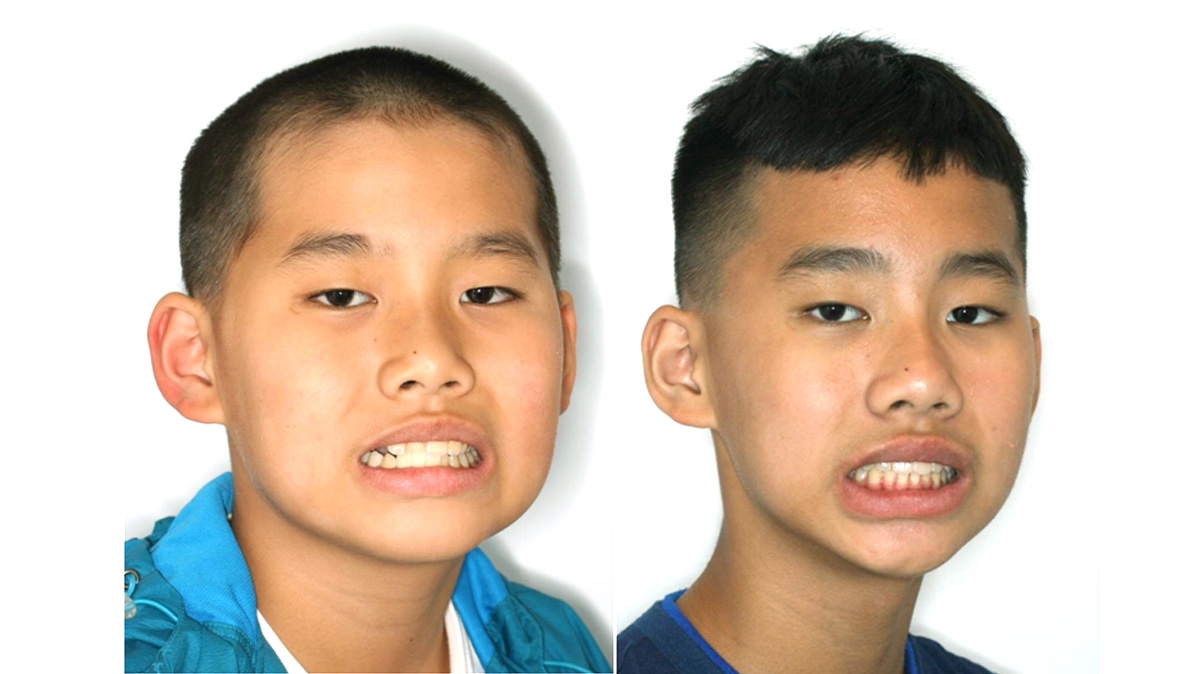 兒童牙齒矯正矯正對照圖二