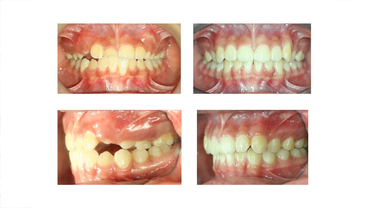 兒童牙齒矯正矯正對照圖三