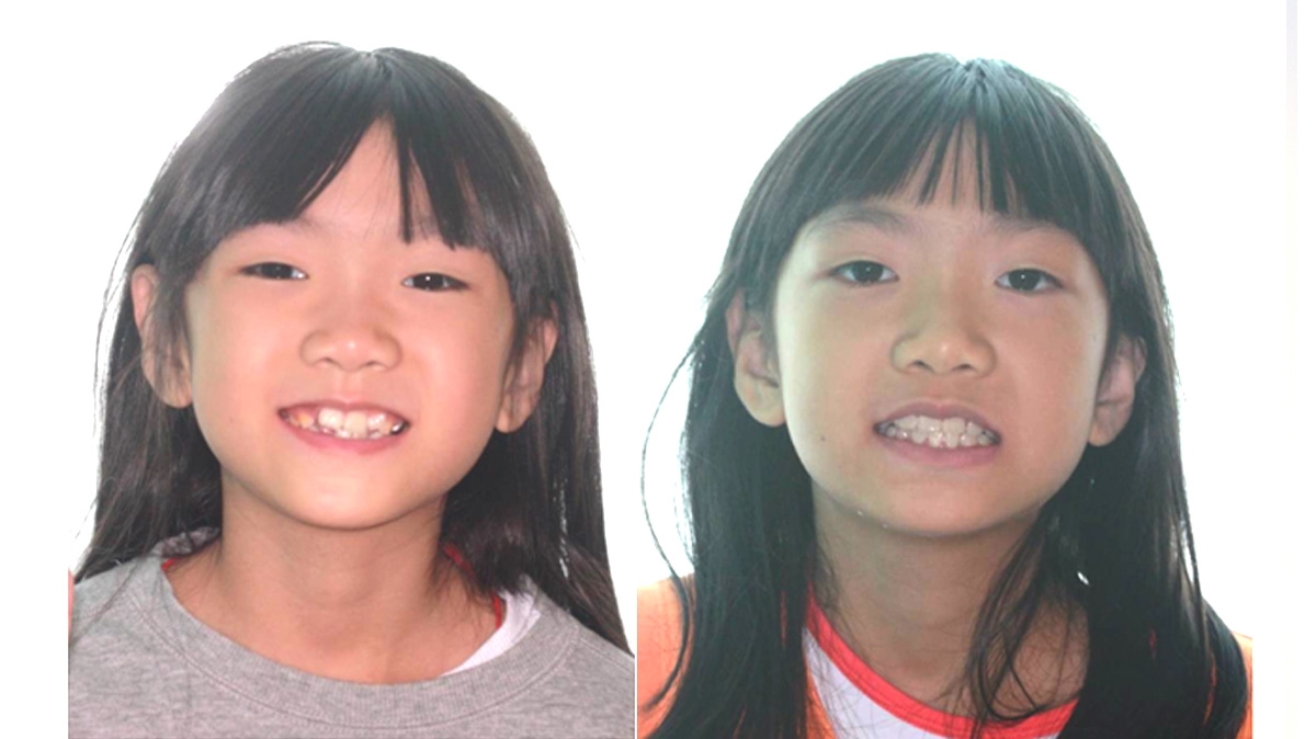 兒童牙齒矯正矯正對照圖