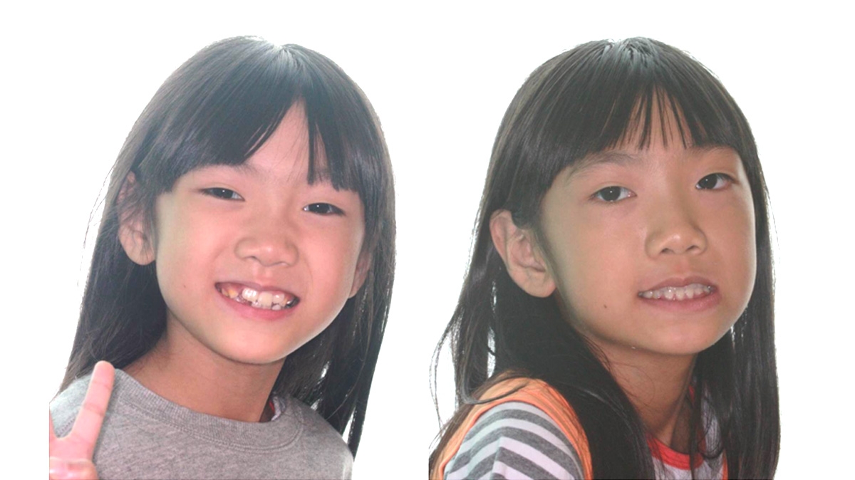 兒童牙齒矯正矯正對照圖二
