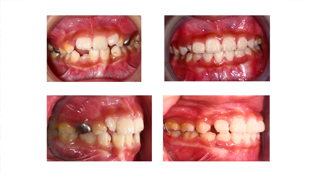 兒童牙齒矯正矯正對照圖三
