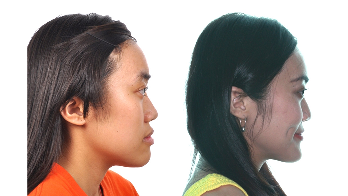 戽斗牙齒矯正對照圖二