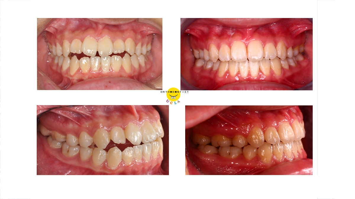 戽斗牙齒矯正對照圖三