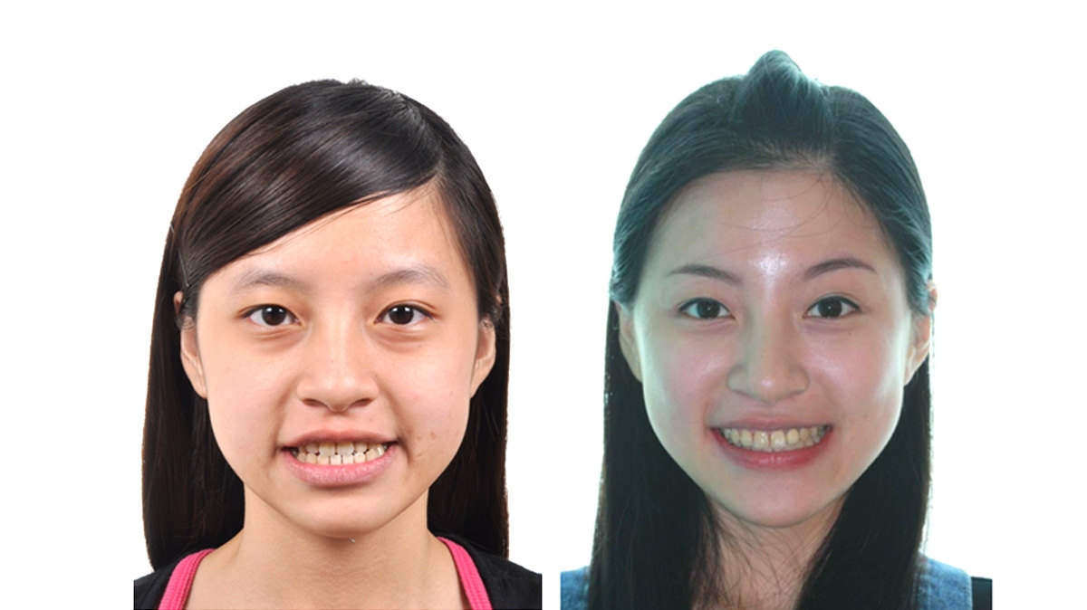 戽斗牙齒矯正對照圖