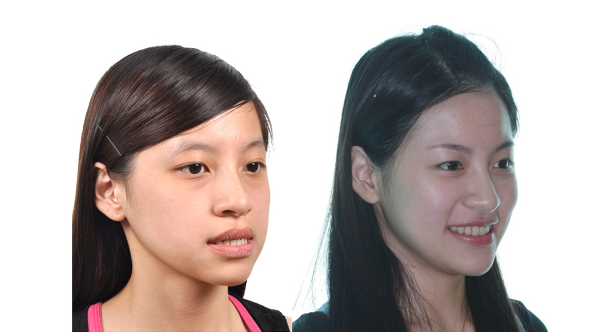 戽斗牙齒矯正對照圖二