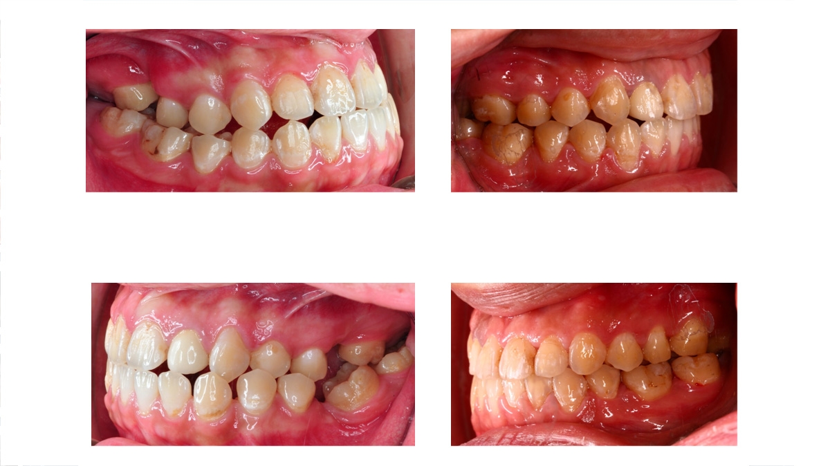 戽斗牙齒矯正對照圖三