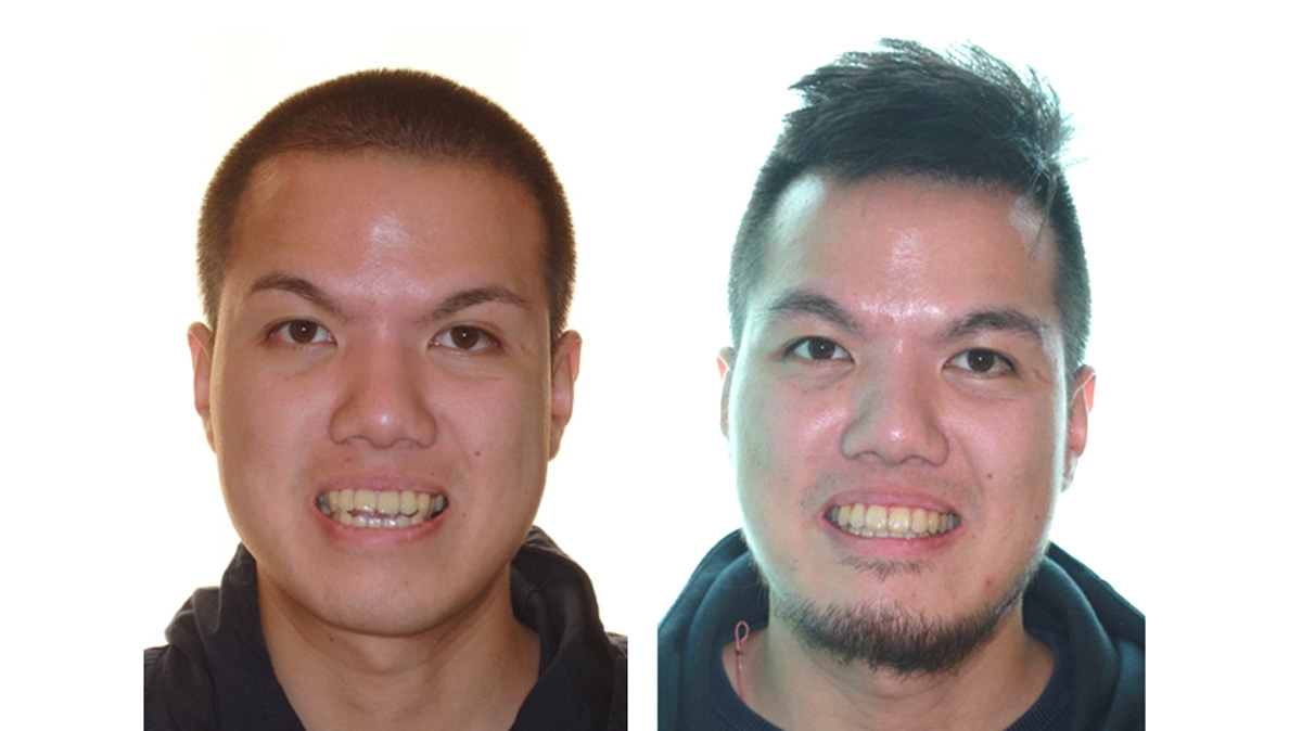 戽斗牙齒矯正對照圖