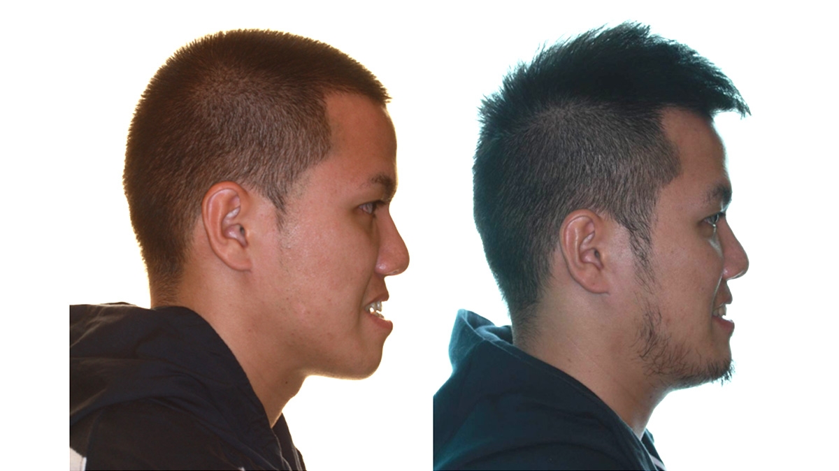 戽斗牙齒矯正對照圖二