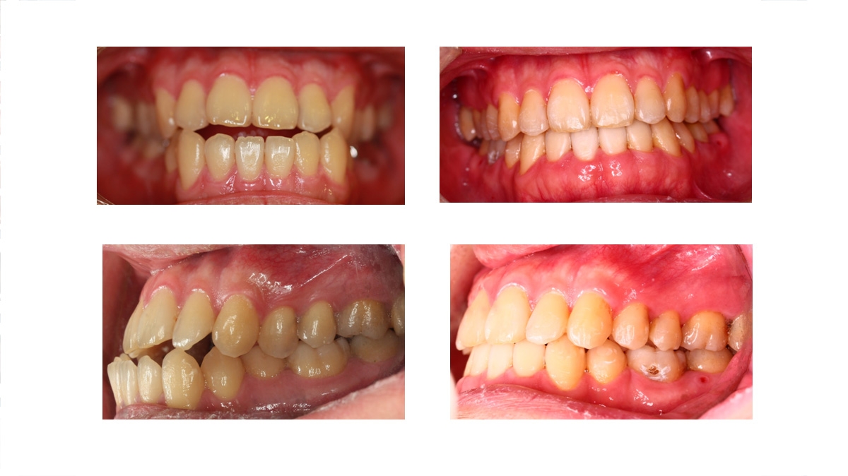 戽斗牙齒矯正對照圖三