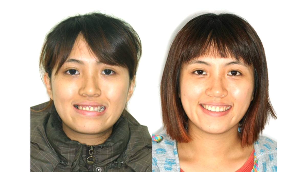 戽斗牙齒矯正對照圖