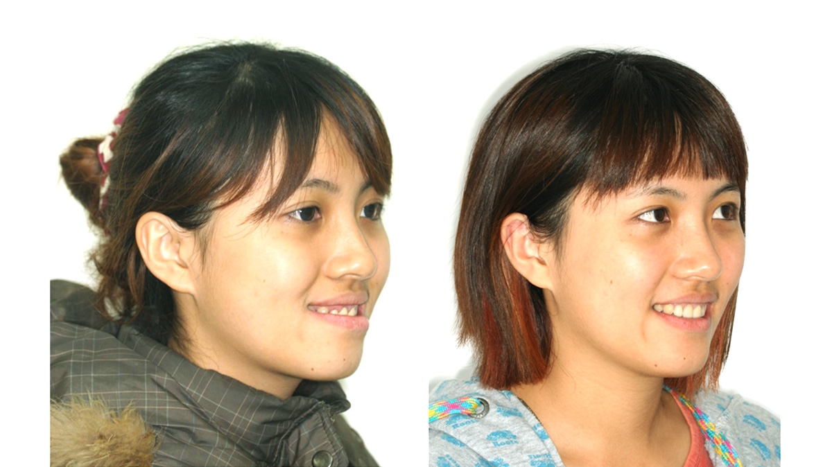 戽斗牙齒矯正對照圖二