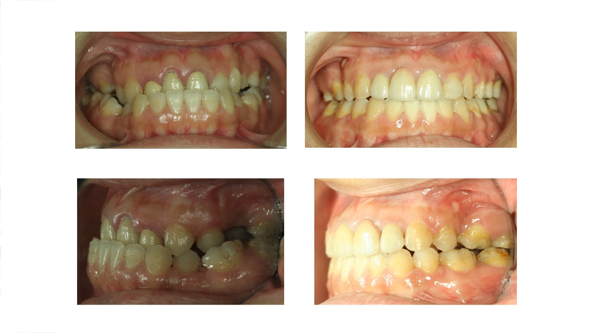 戽斗牙齒矯正對照圖三