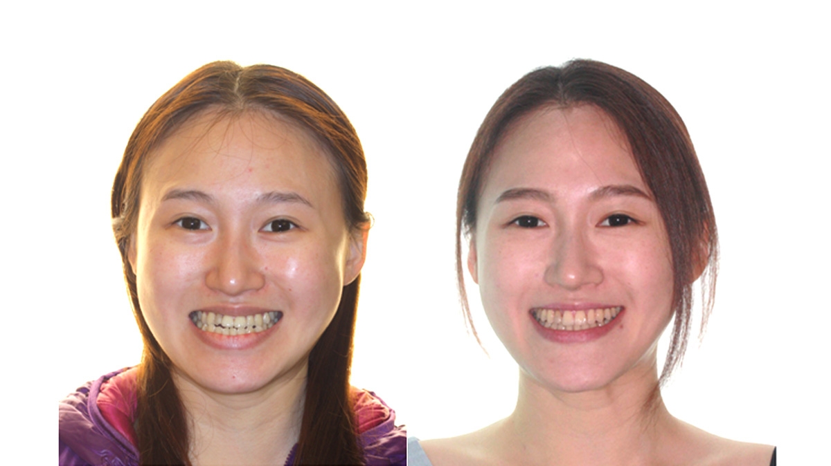 戽斗牙齒矯正對照圖