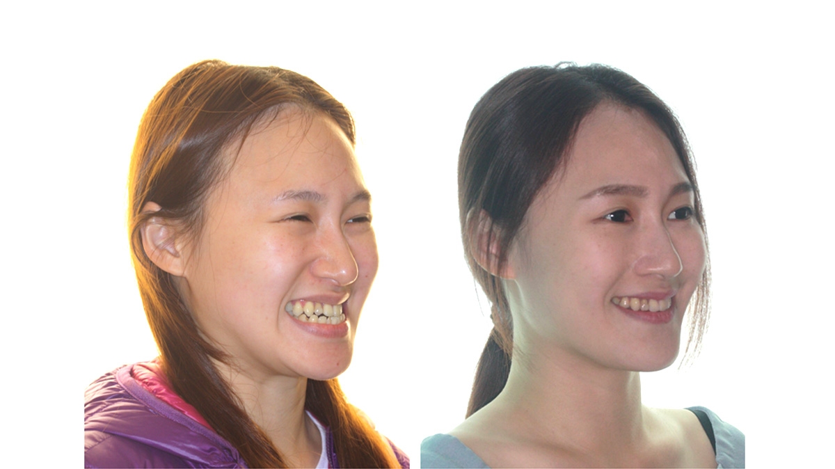 戽斗牙齒矯正對照圖二