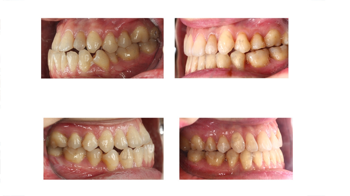 戽斗牙齒矯正對照圖三