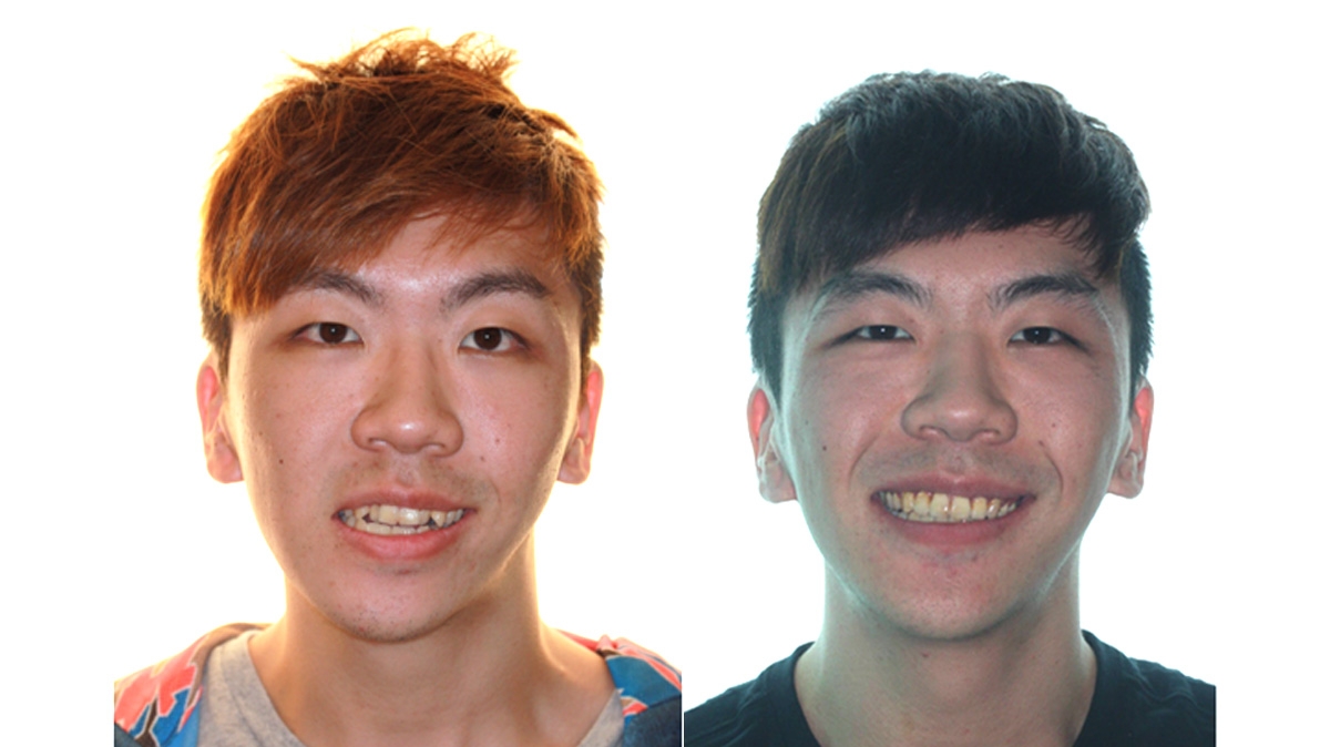 戽斗牙齒矯正對照圖