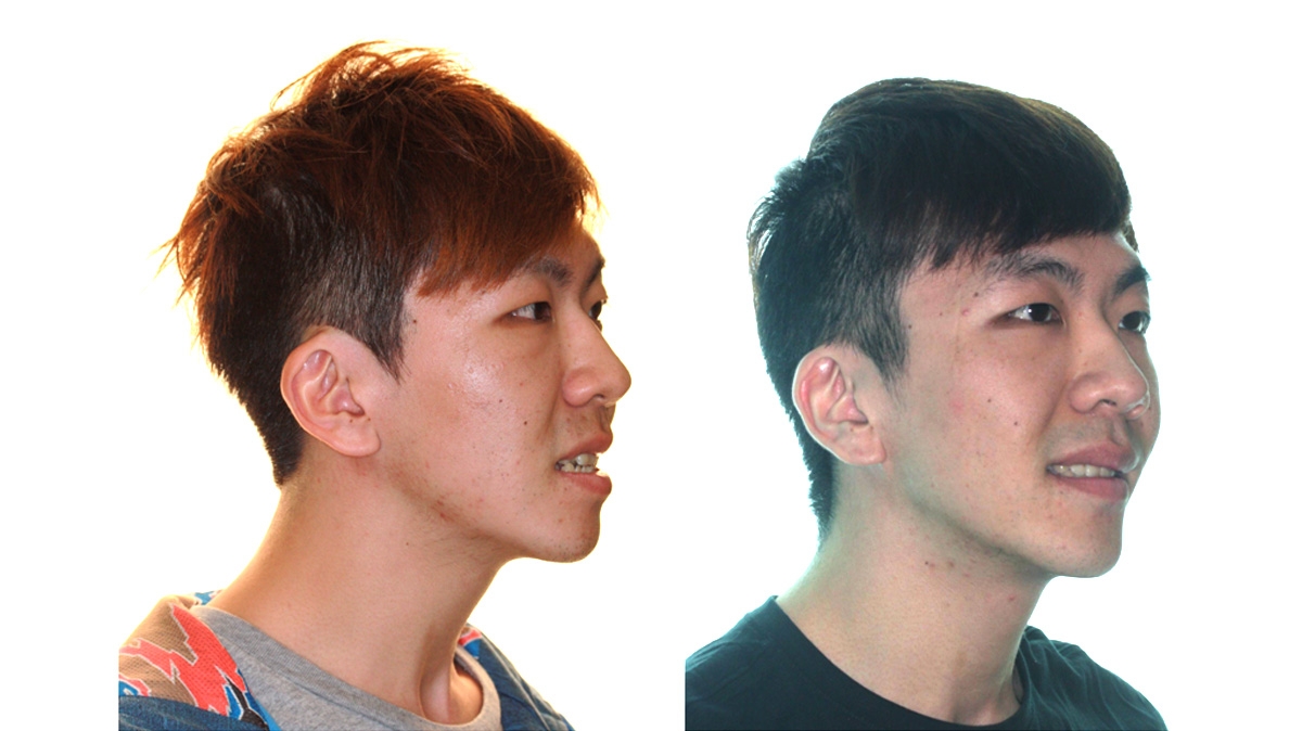 戽斗牙齒矯正對照圖二