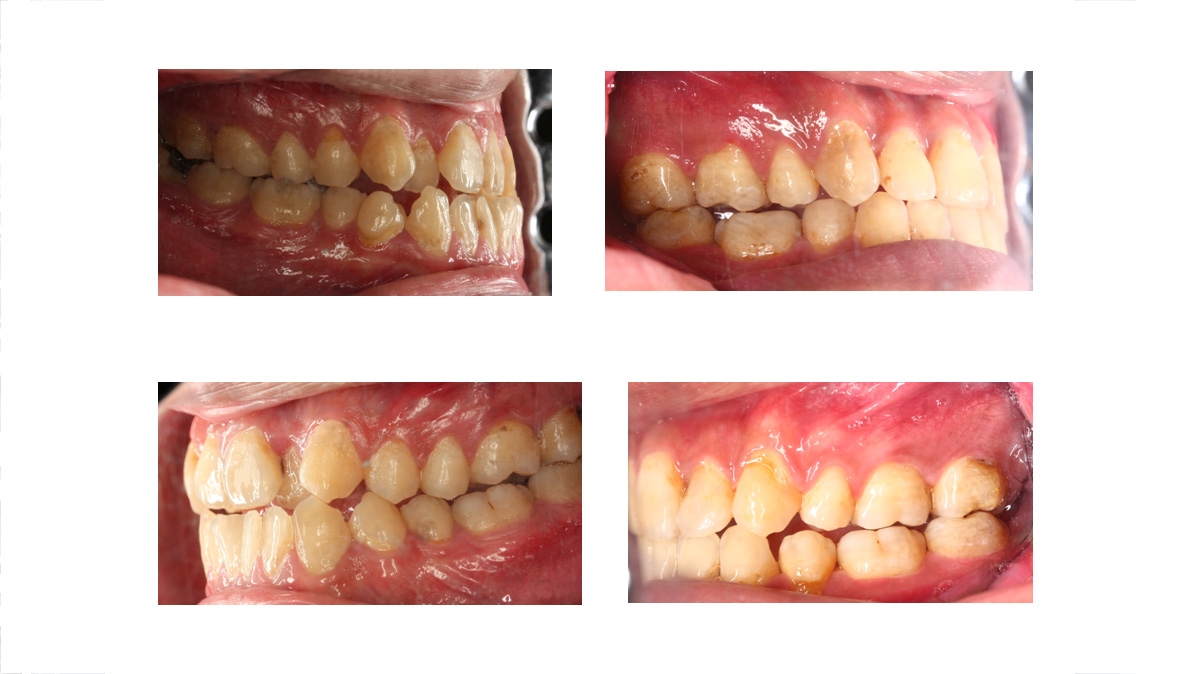 戽斗牙齒矯正對照圖三
