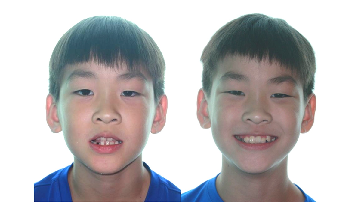 戽斗牙齒矯正對照圖