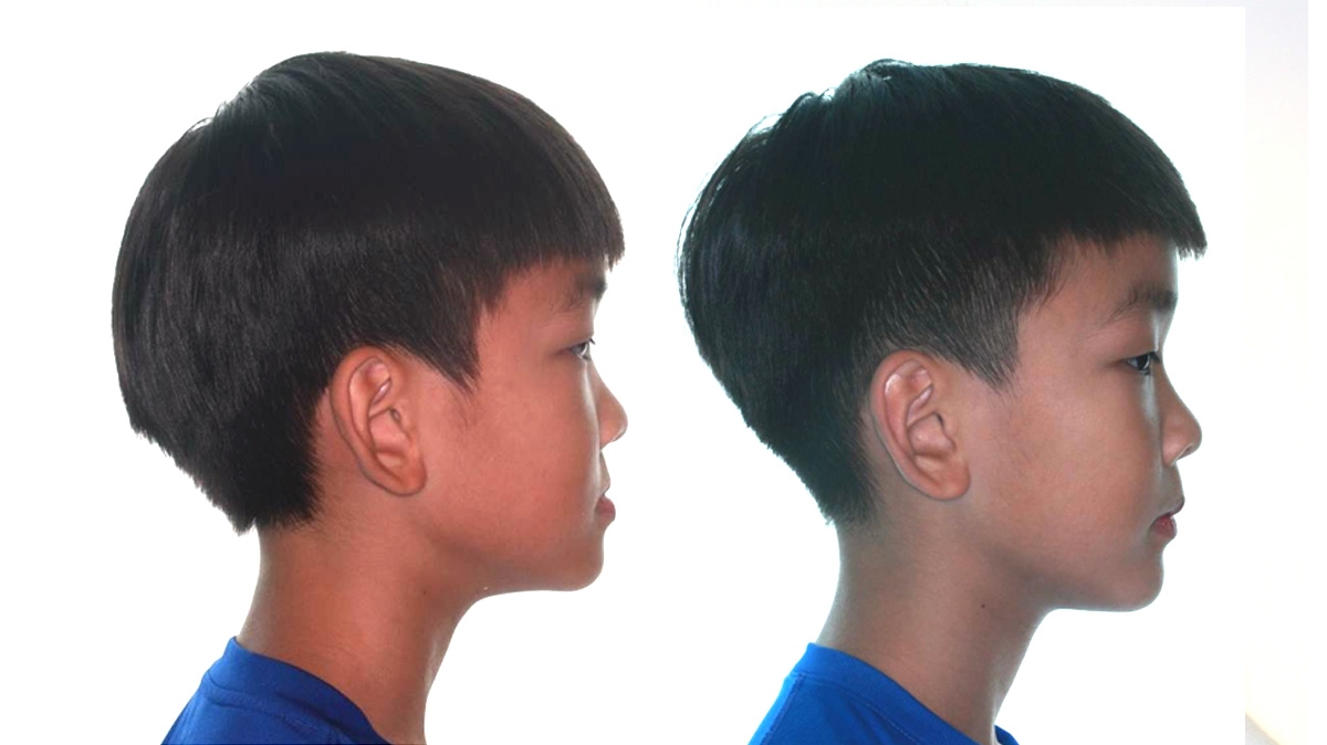 戽斗牙齒矯正對照圖二