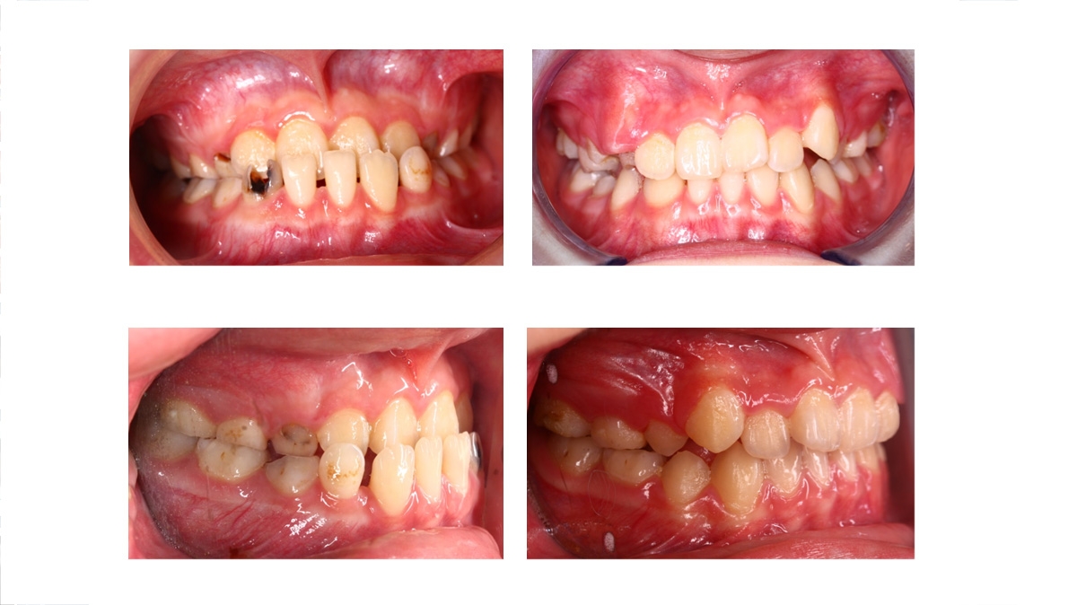 戽斗牙齒矯正對照圖三