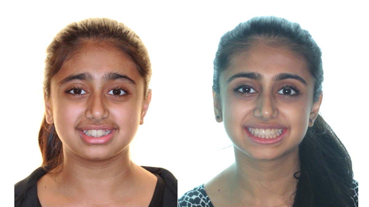 混亂擁擠牙齒矯正對照圖