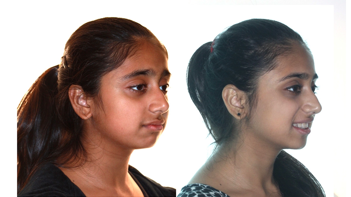 混亂擁擠牙齒矯正對照圖二