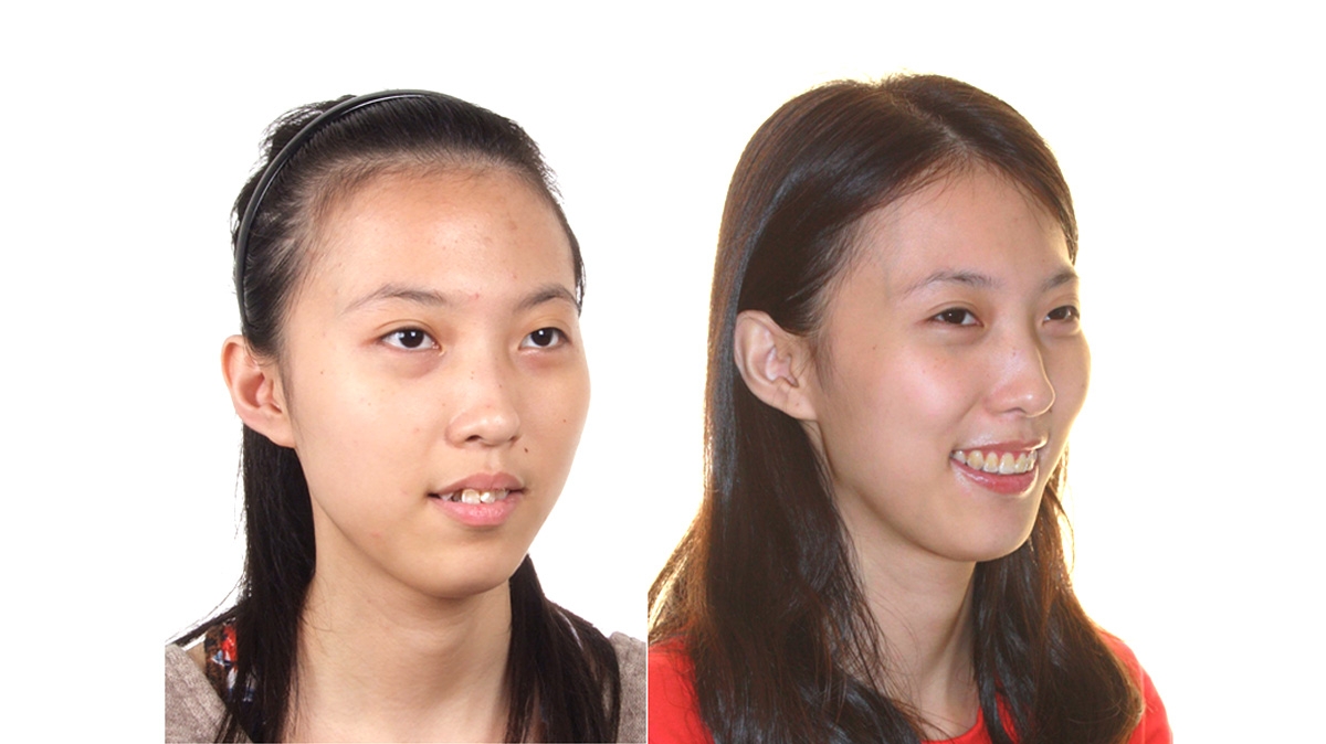 混亂擁擠牙齒矯正對照圖二