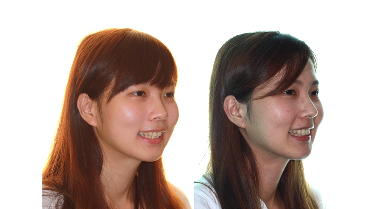 混亂擁擠牙齒矯正對照圖二