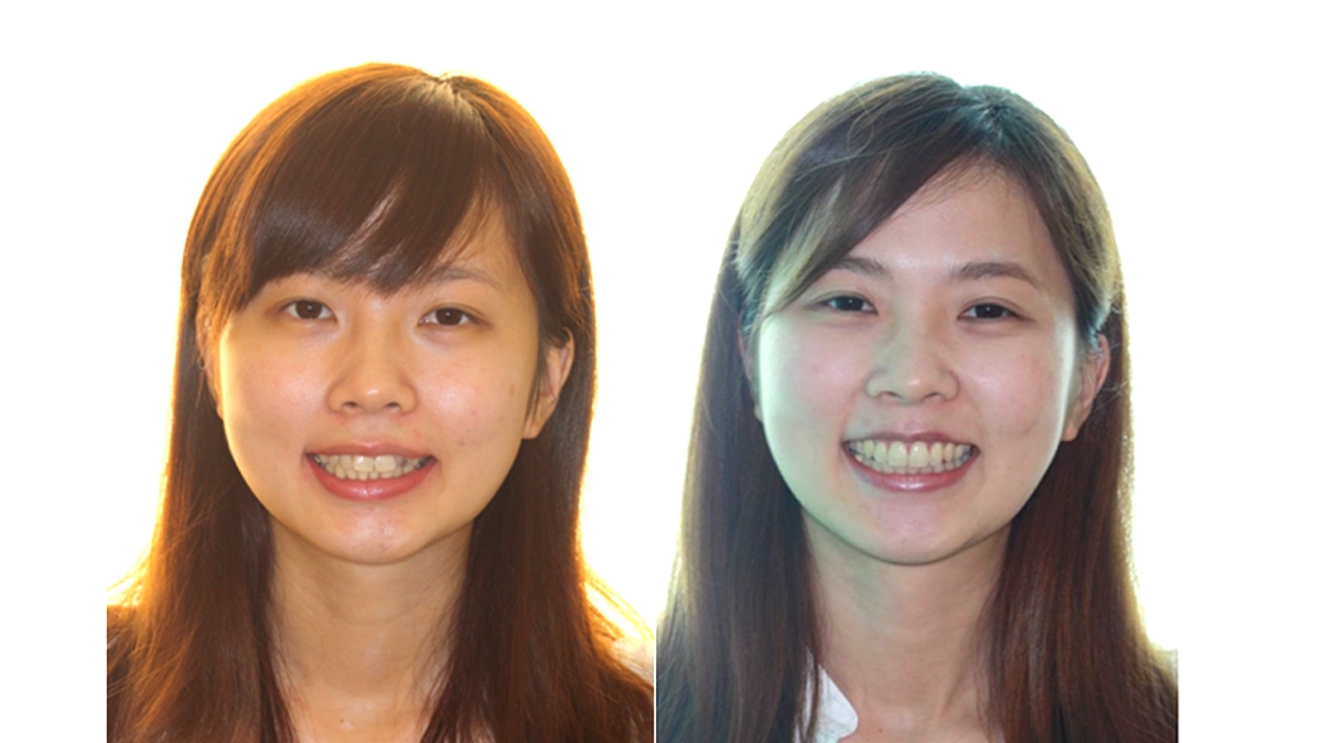 混亂擁擠牙齒矯正對照圖