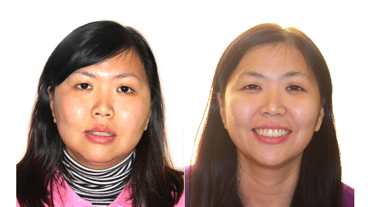 混亂擁擠牙齒矯正對照圖