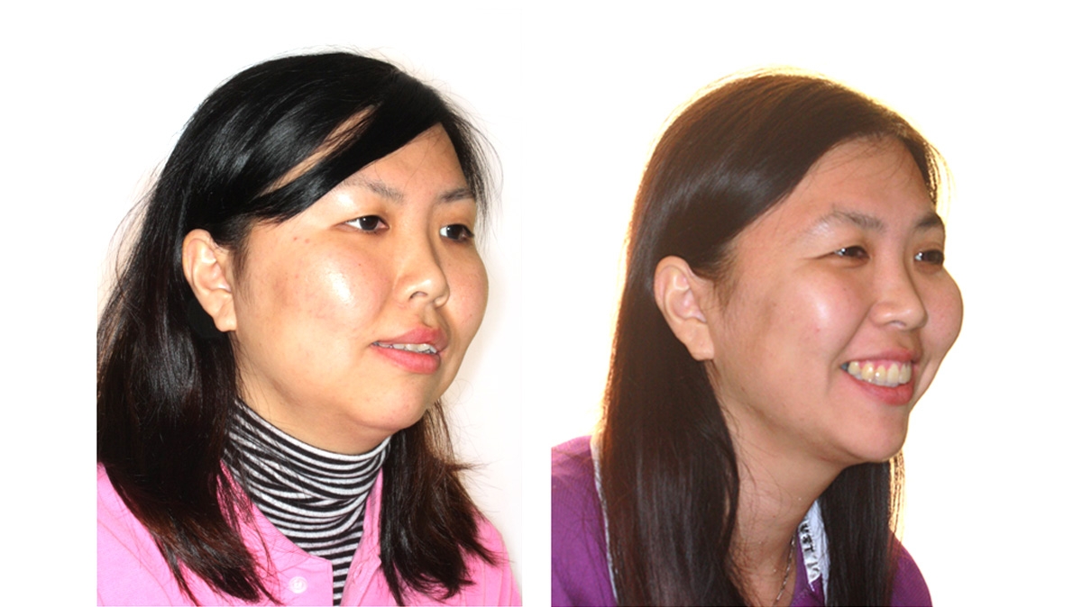 混亂擁擠牙齒矯正對照圖二