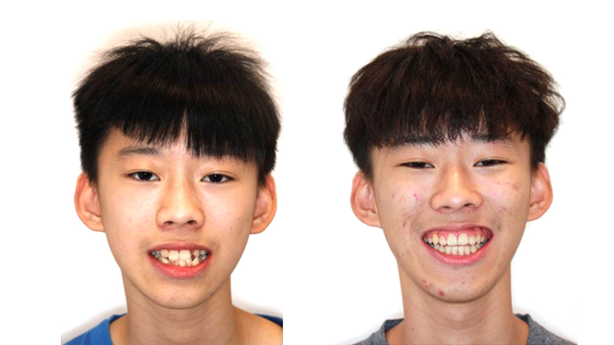 混亂擁擠牙齒矯正對照圖