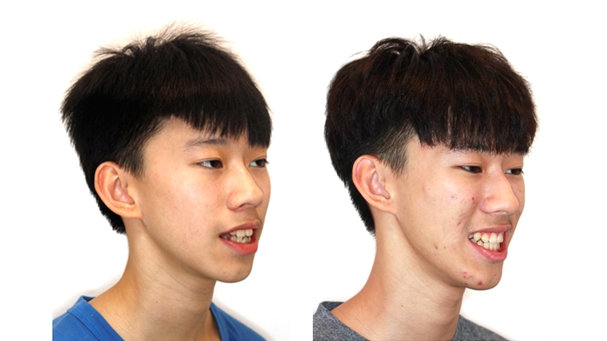 混亂擁擠牙齒矯正對照圖二