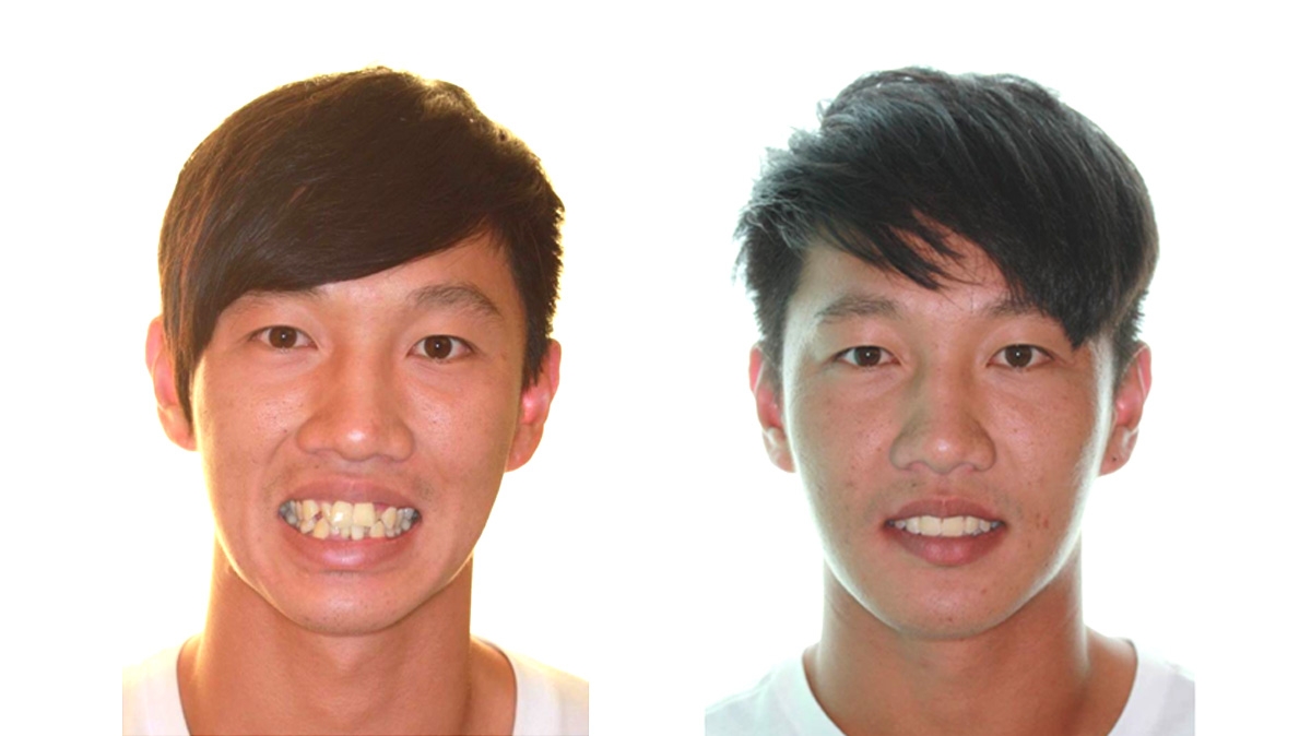 混亂擁擠牙齒矯正對照圖