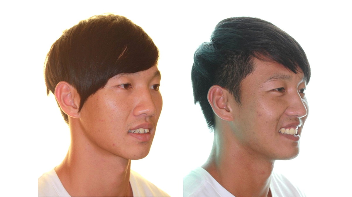 混亂擁擠牙齒矯正對照圖二