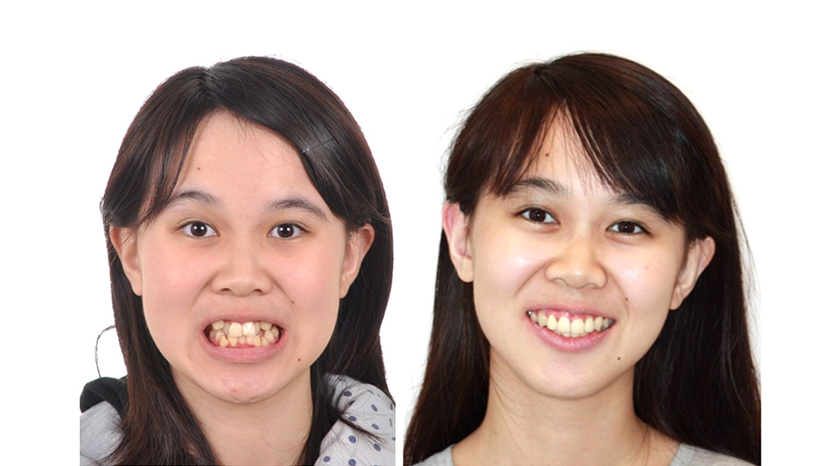 混亂擁擠牙齒矯正對照圖