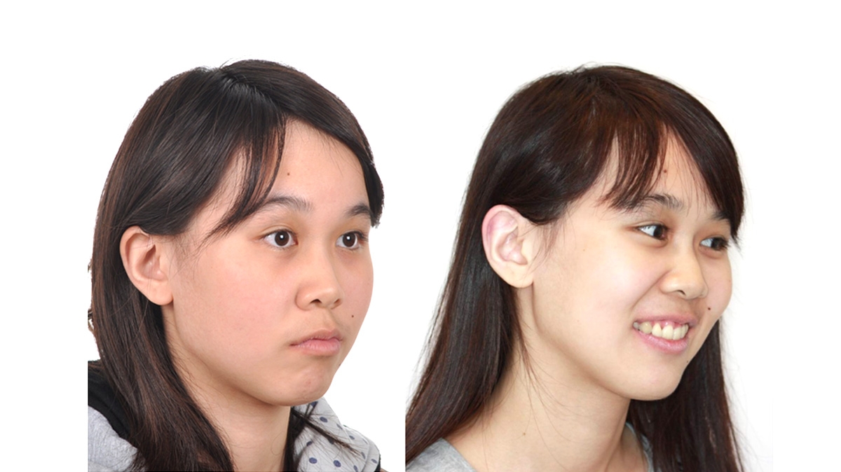 混亂擁擠牙齒矯正對照圖二