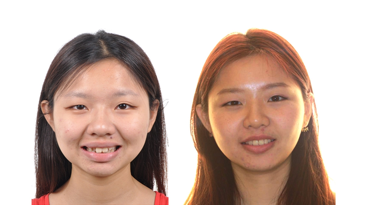 混亂擁擠牙齒矯正對照圖