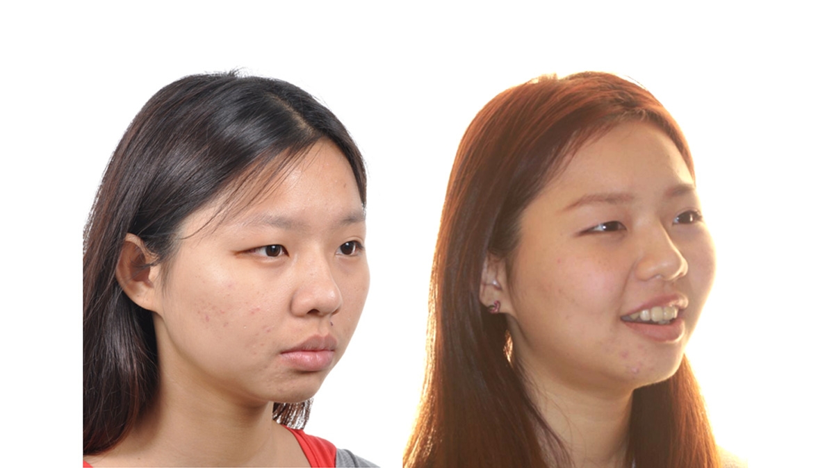 混亂擁擠牙齒矯正對照圖二